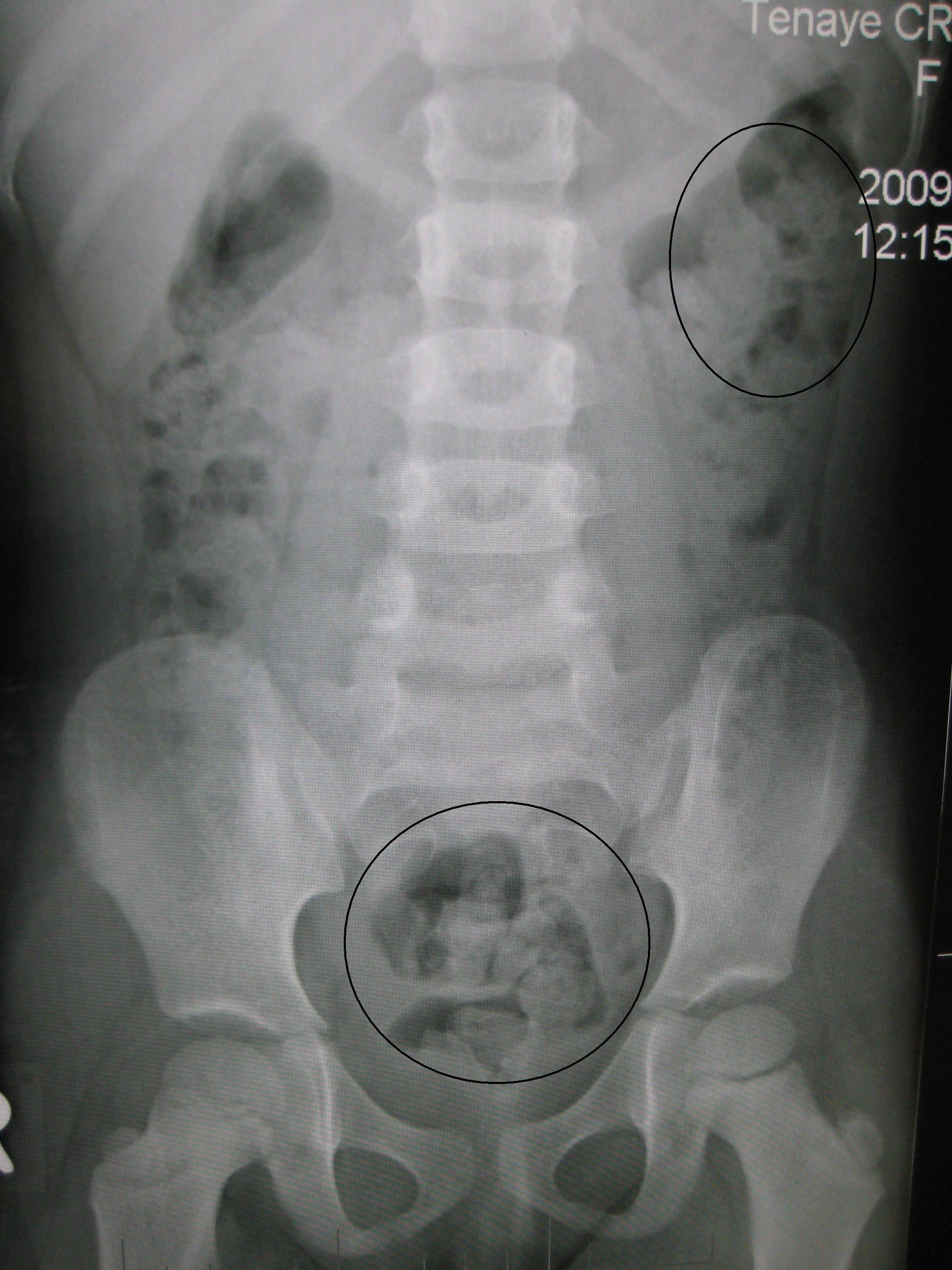FileConstipation.JPG Wikipedia
