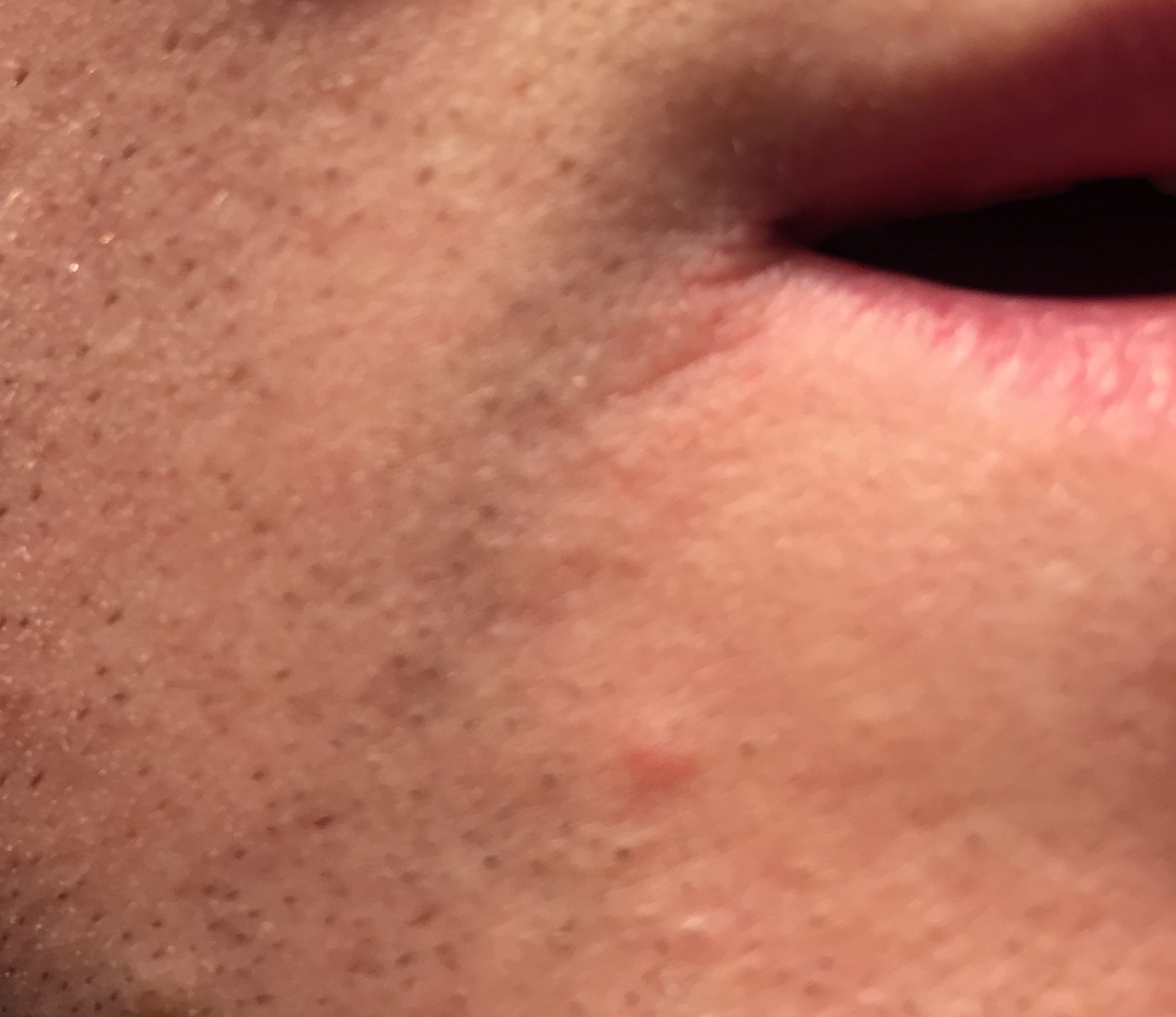 File Angular Cheilitis Jpeg Wikipedia