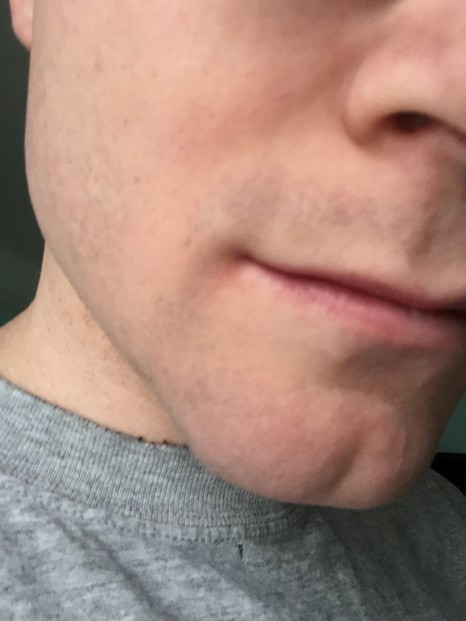 File Angular Cheilitis Discoloration Jpeg Wikipedia