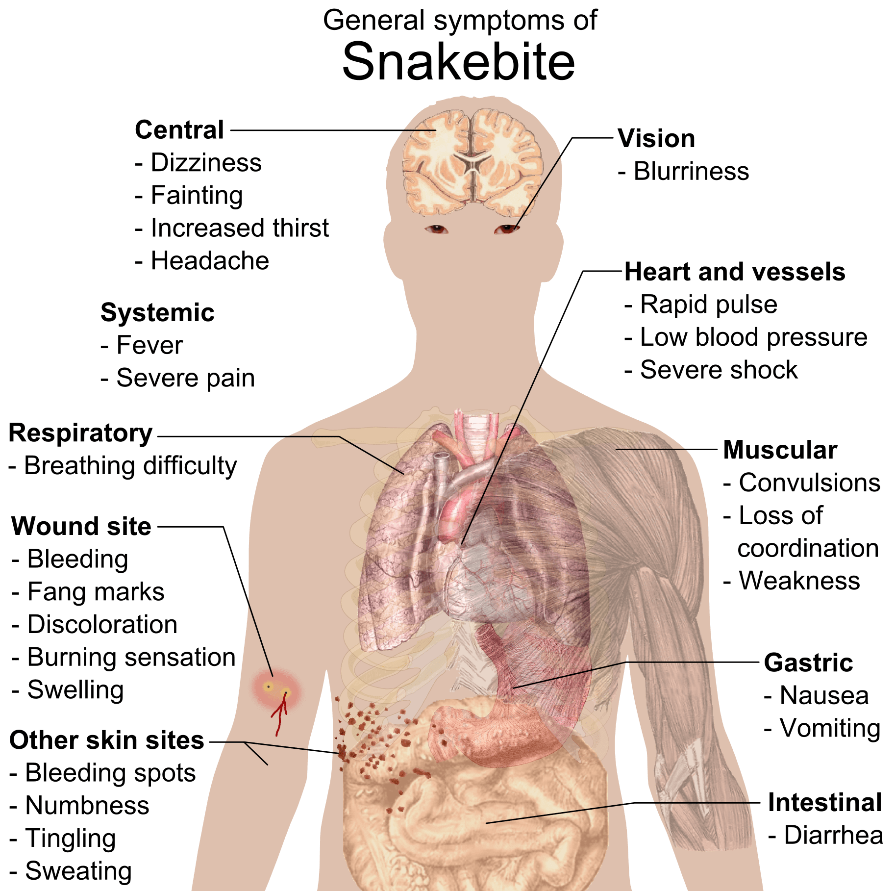 FileSnake bite symptoms.png