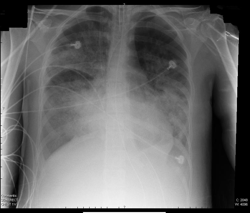 FileARDS XRay.jpg Wikimedia Commons