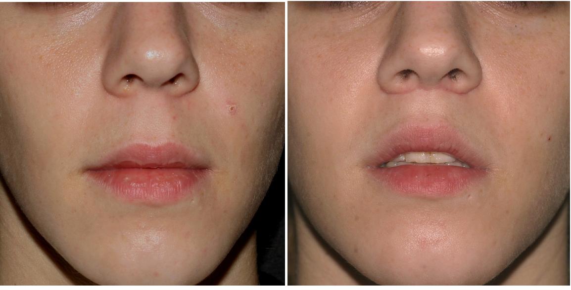 FileLip Lift Before & After.JPG Wikimedia Commons