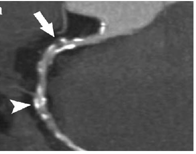 Angiogram Ct Scan Jantung - Wikipedia Bahasa Indonesia, Ensiklopedia Bebas