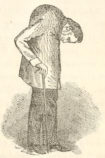 Ankylosing Spondylitis Wikiwand