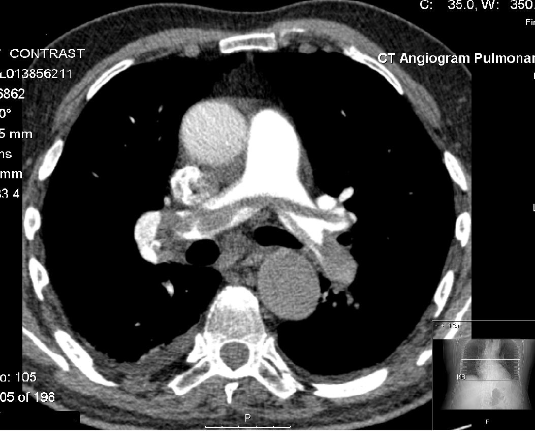 CT pulmonary angiogram Wikipedia