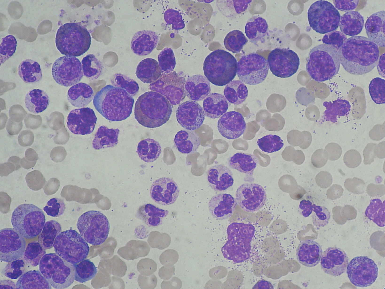 Leukemia