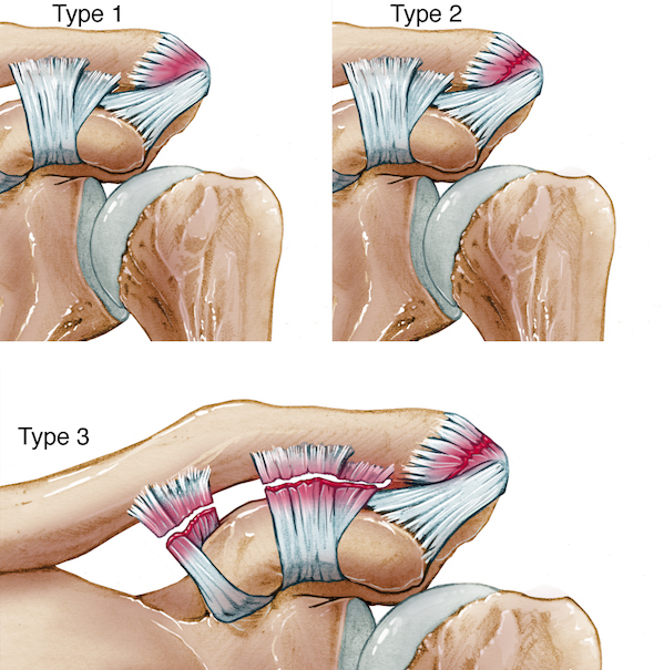 Acromioclavicular joint injury