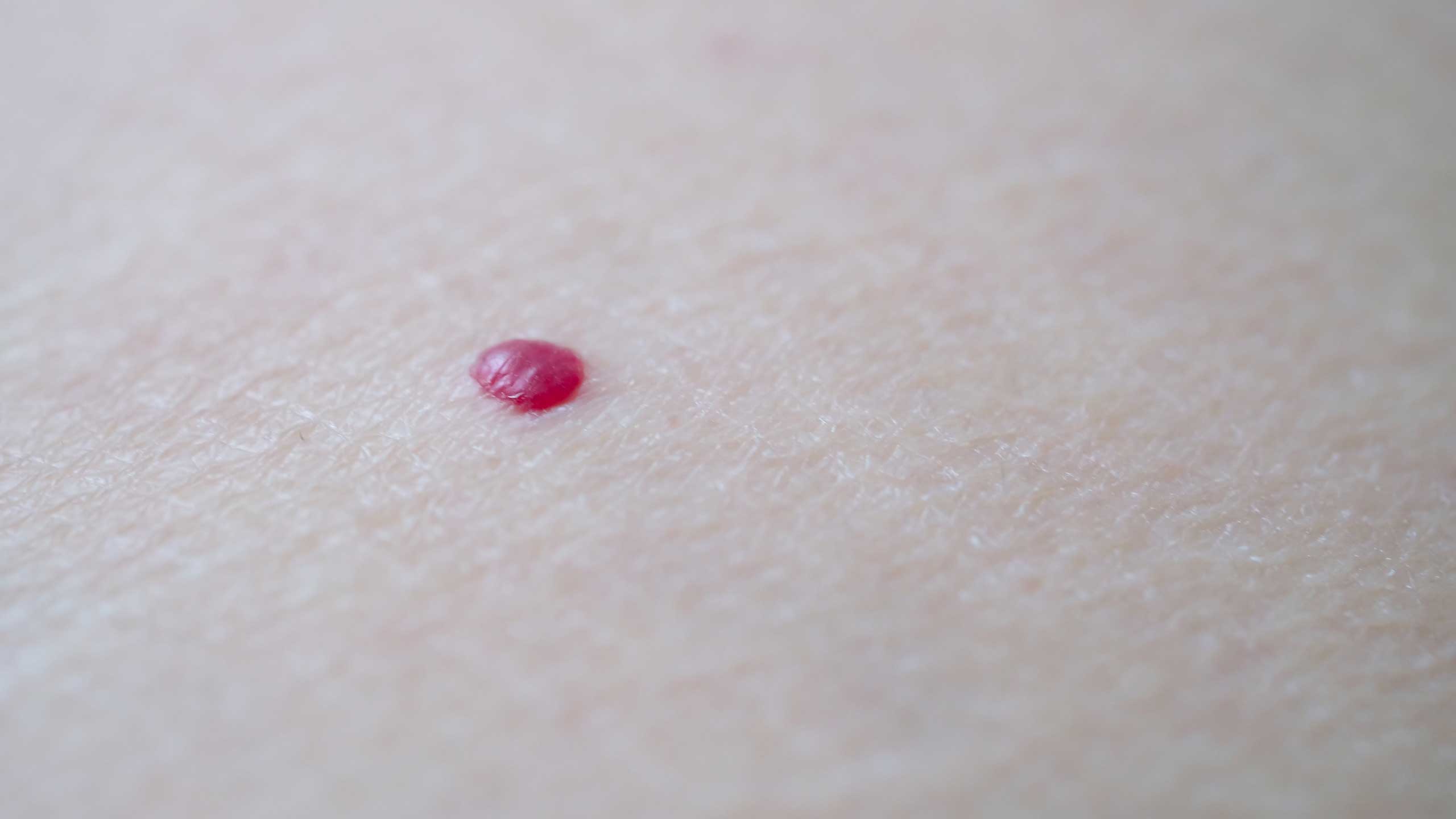 What causes Cherry Angioma and what treatments are there?