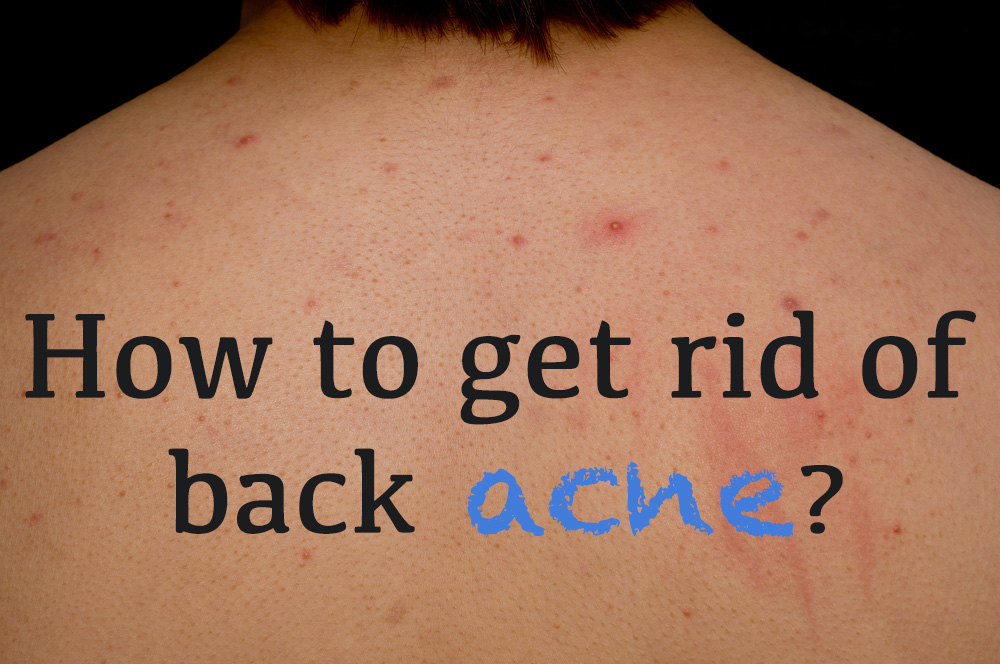 What Causes Backne And How To Rid Yourself Of It