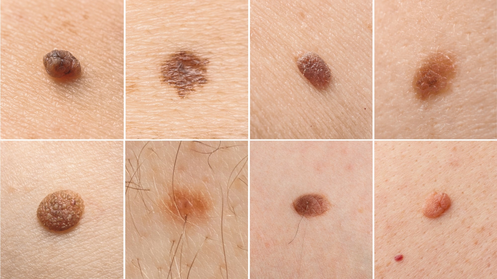 Understanding the different types of moles Spot Check Clinic