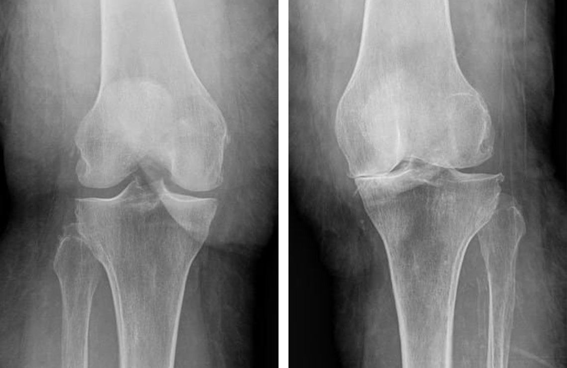 Total Knee Arthroplasty When to Delay? Axis Sports Med