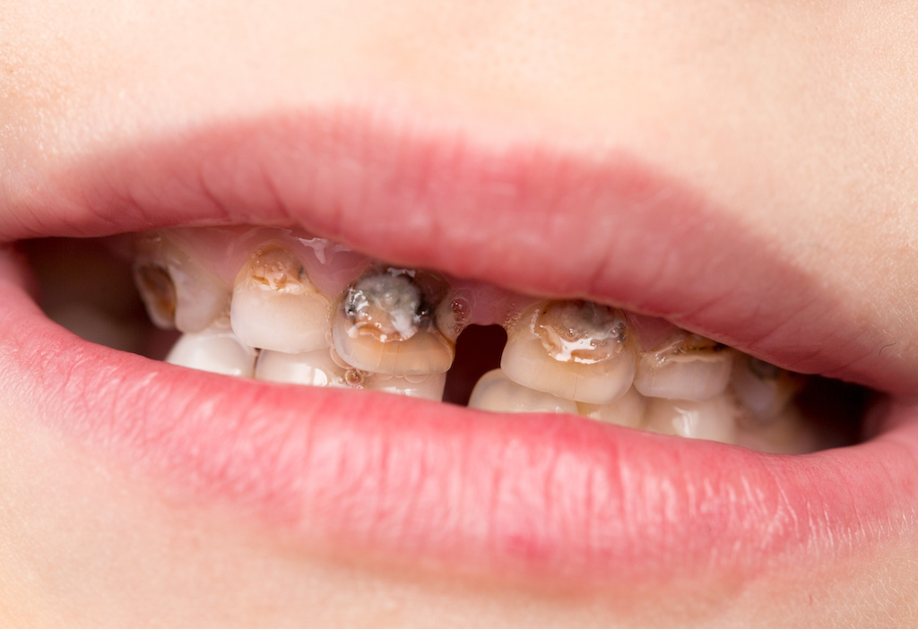 Prevent, Detect and Treat Children’s Tooth Decay