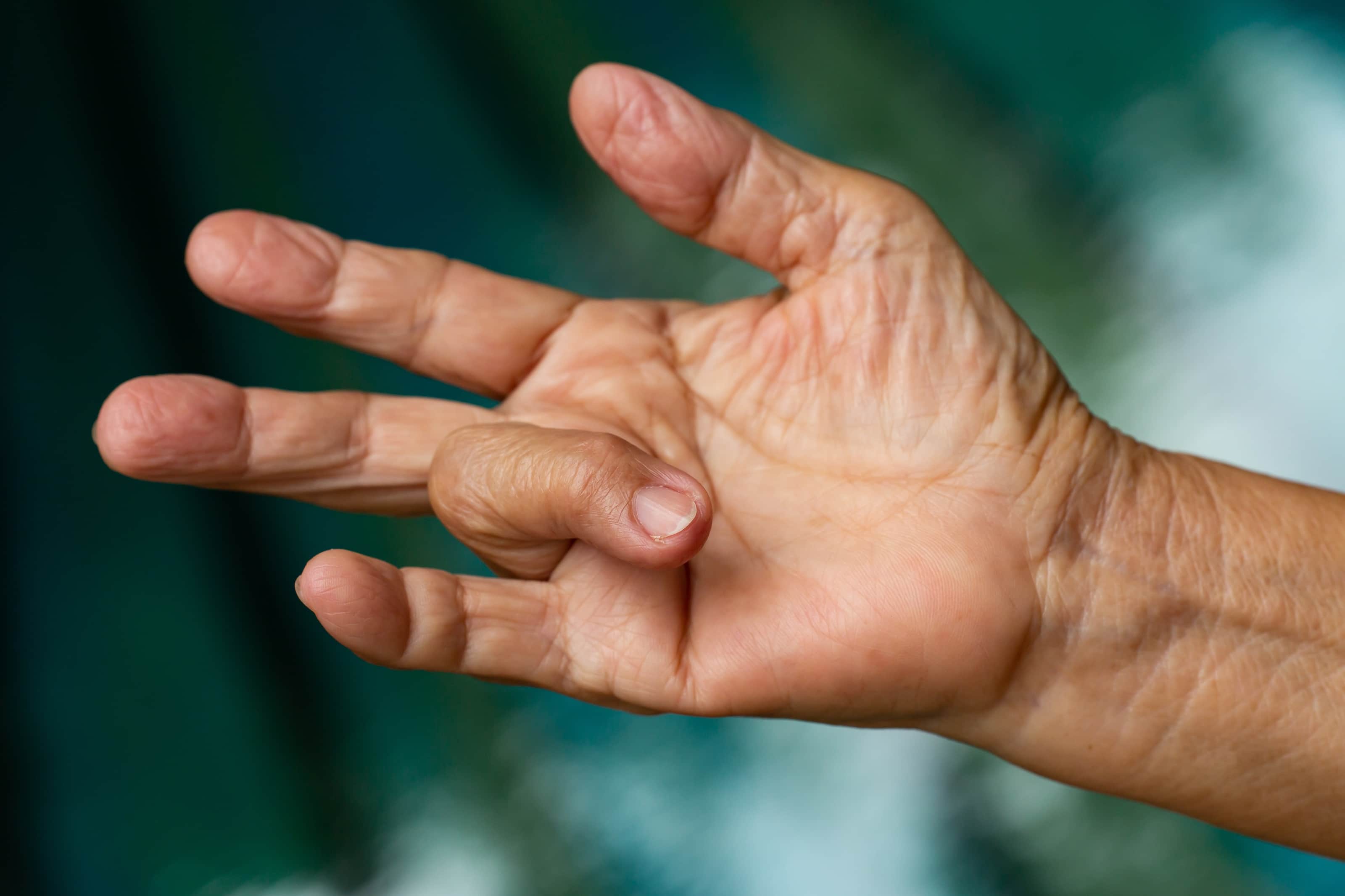 Trigger Finger: Symptoms, Treatments Cleveland Clinic