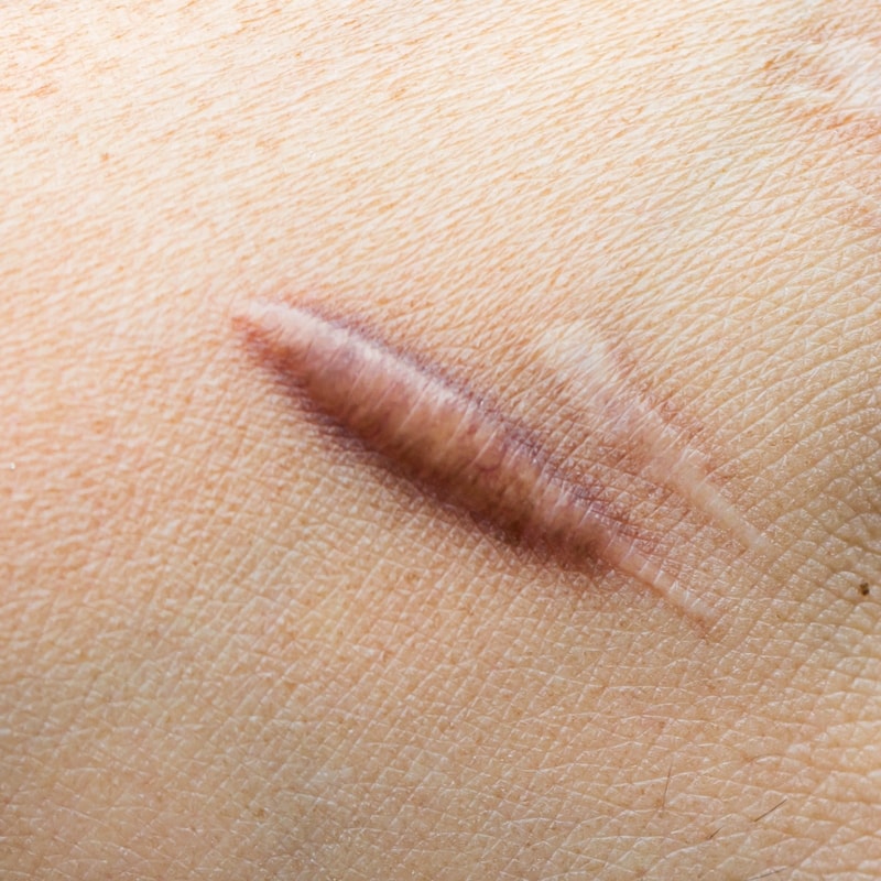 Keloid Treatment in Toronto Keloid Scar Removal in Toronto