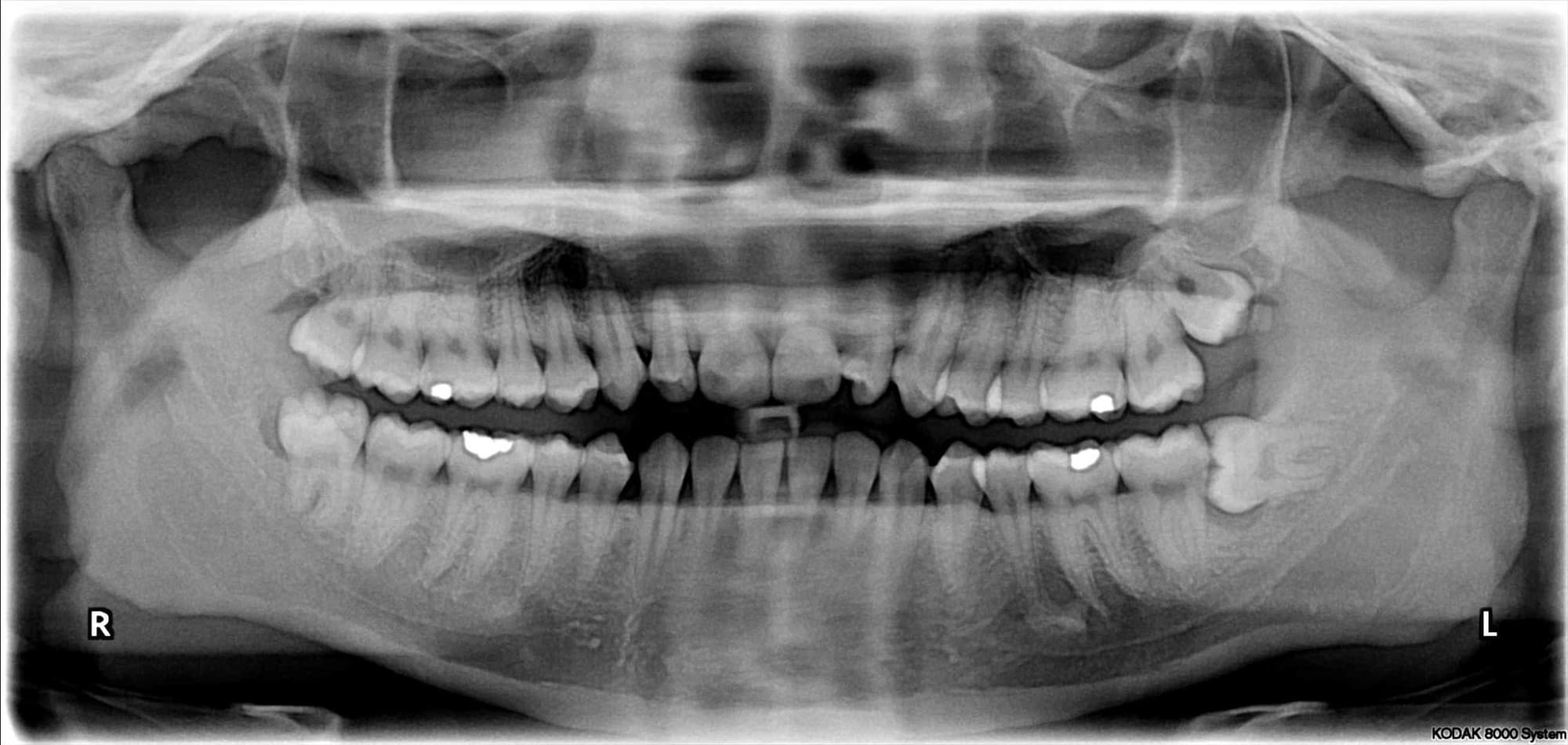 Wisdom Teeth Can I Keep Them Or Do They Need to Come Out?