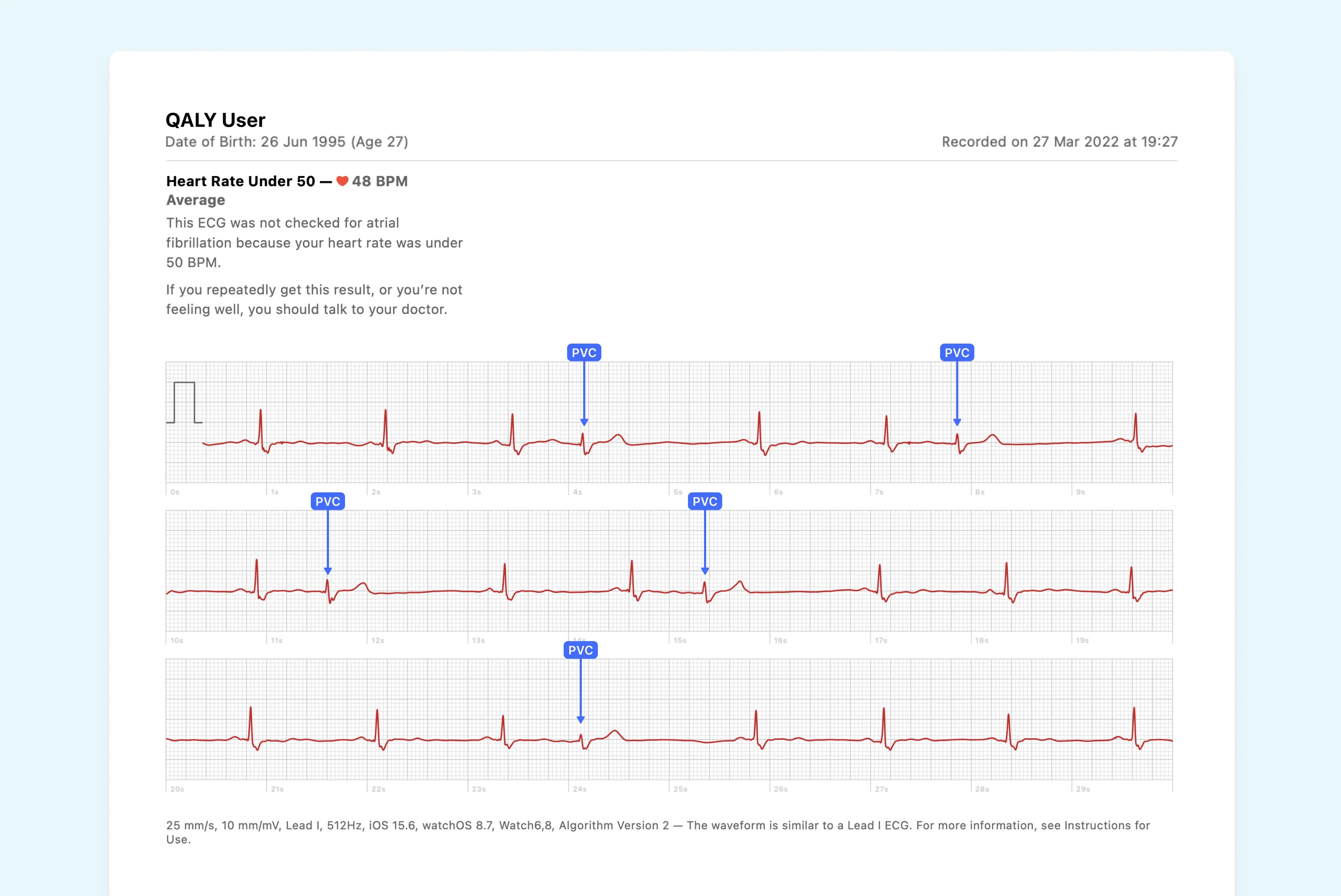 What Ventricular Trigeminy Looks Like on Your Watch ECG Qaly
