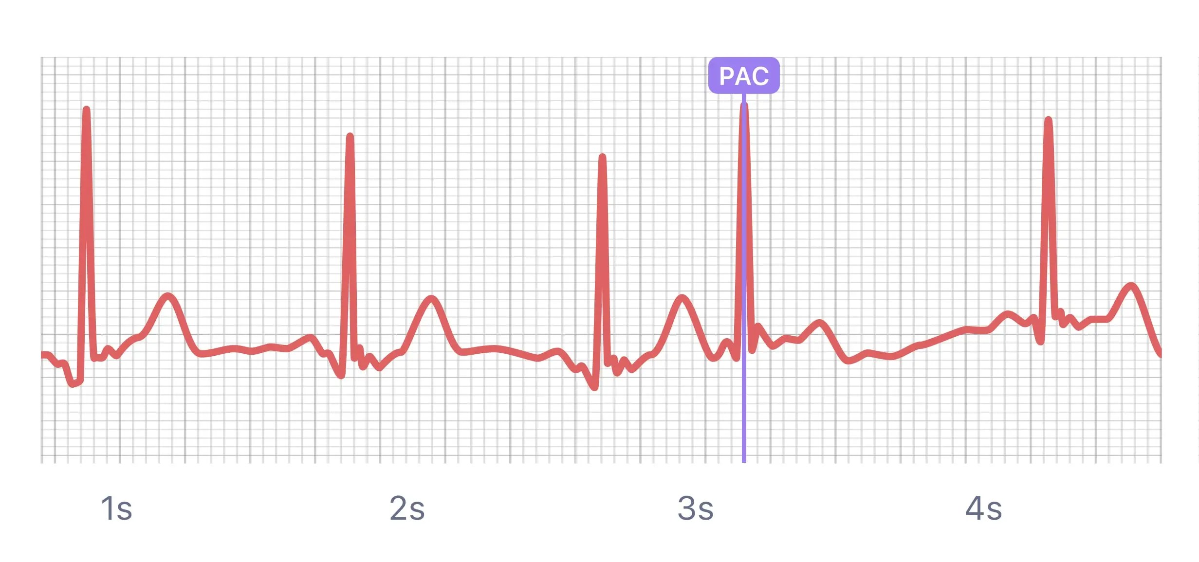 What Heart Palpitations and Irregular Heartbeats Look Like on Your