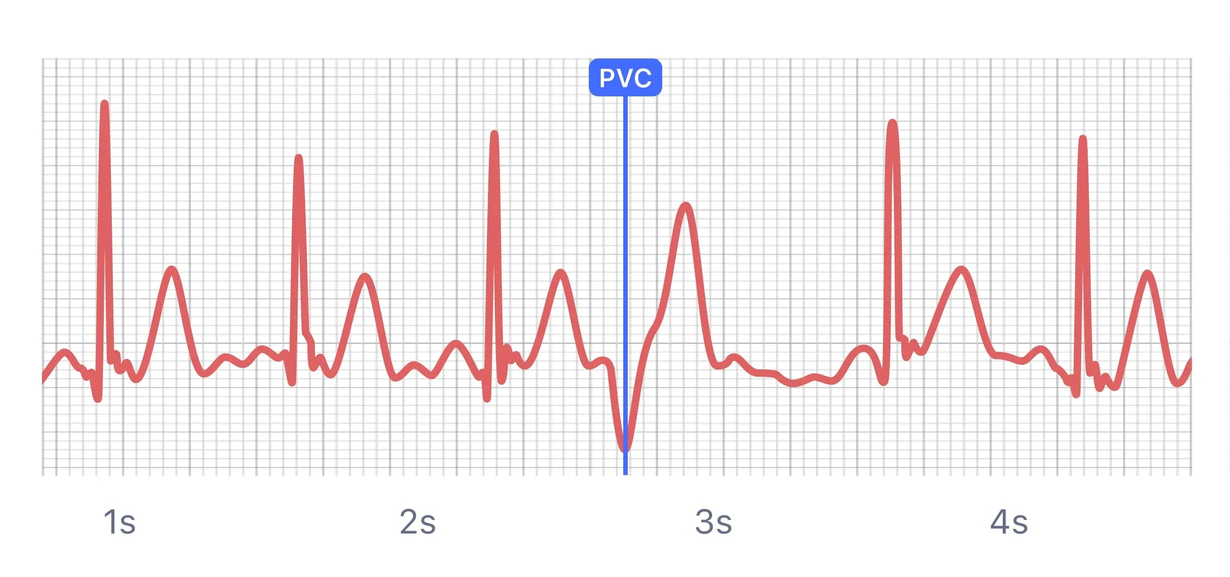 What Heart Palpitations and Irregular Heartbeats Look Like on Your