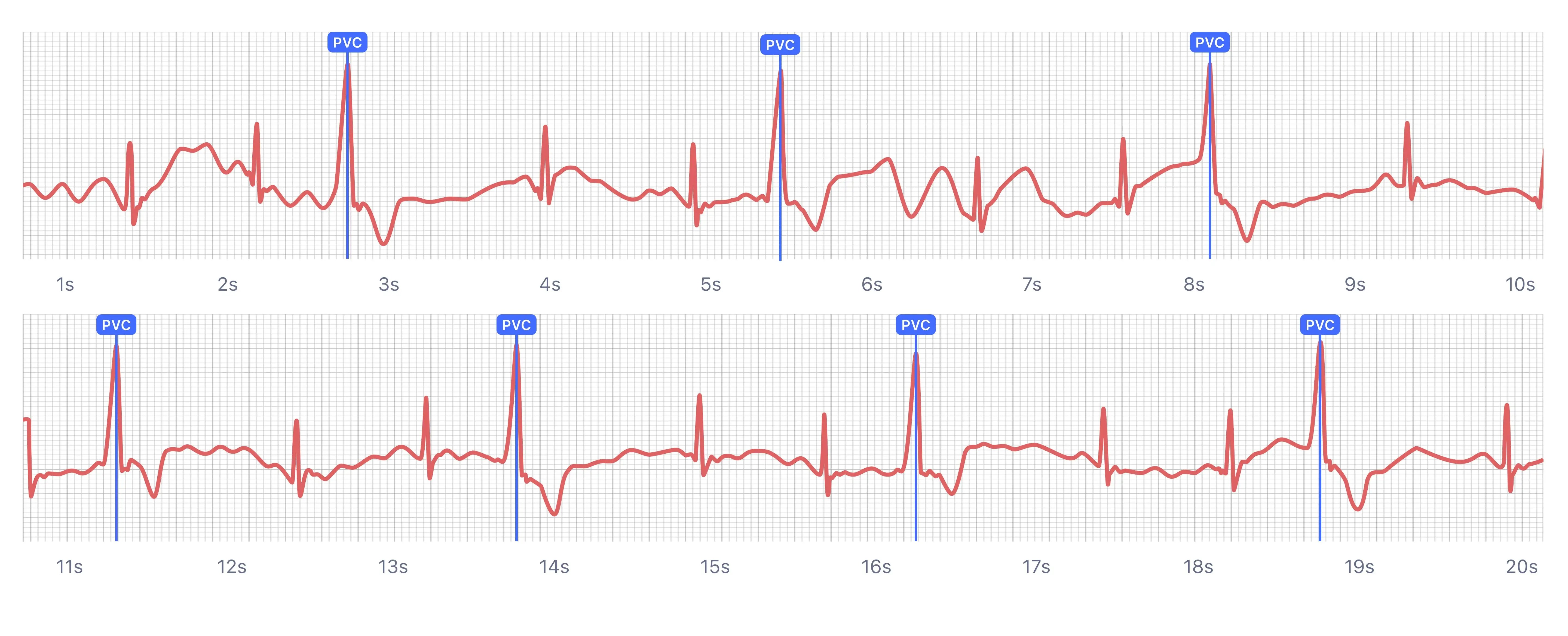 What Heart Palpitations and Irregular Heartbeats Look Like on Your