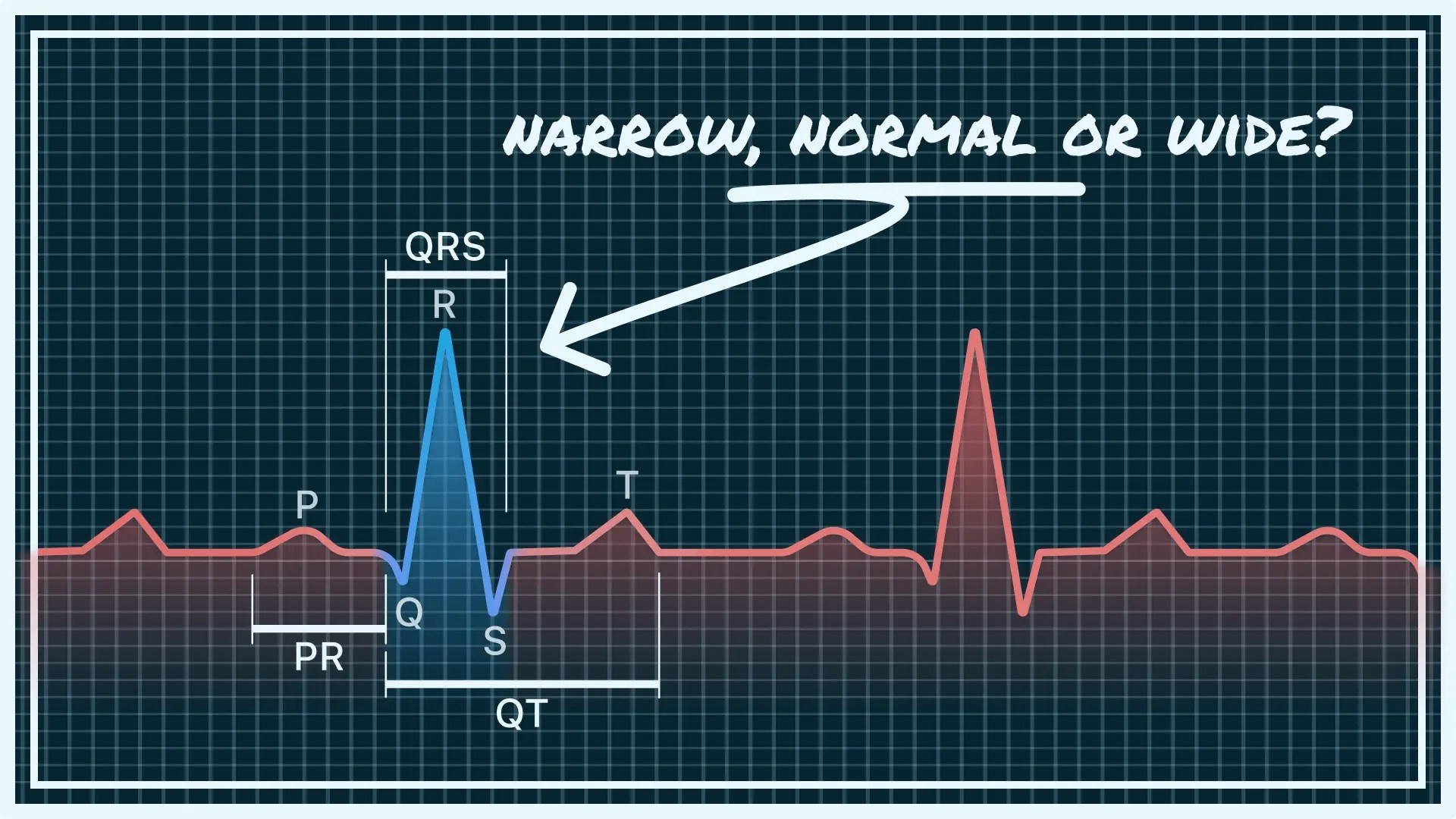 QRS Interval on Your Watch ECG Narrow, Normal, and Wide Qaly