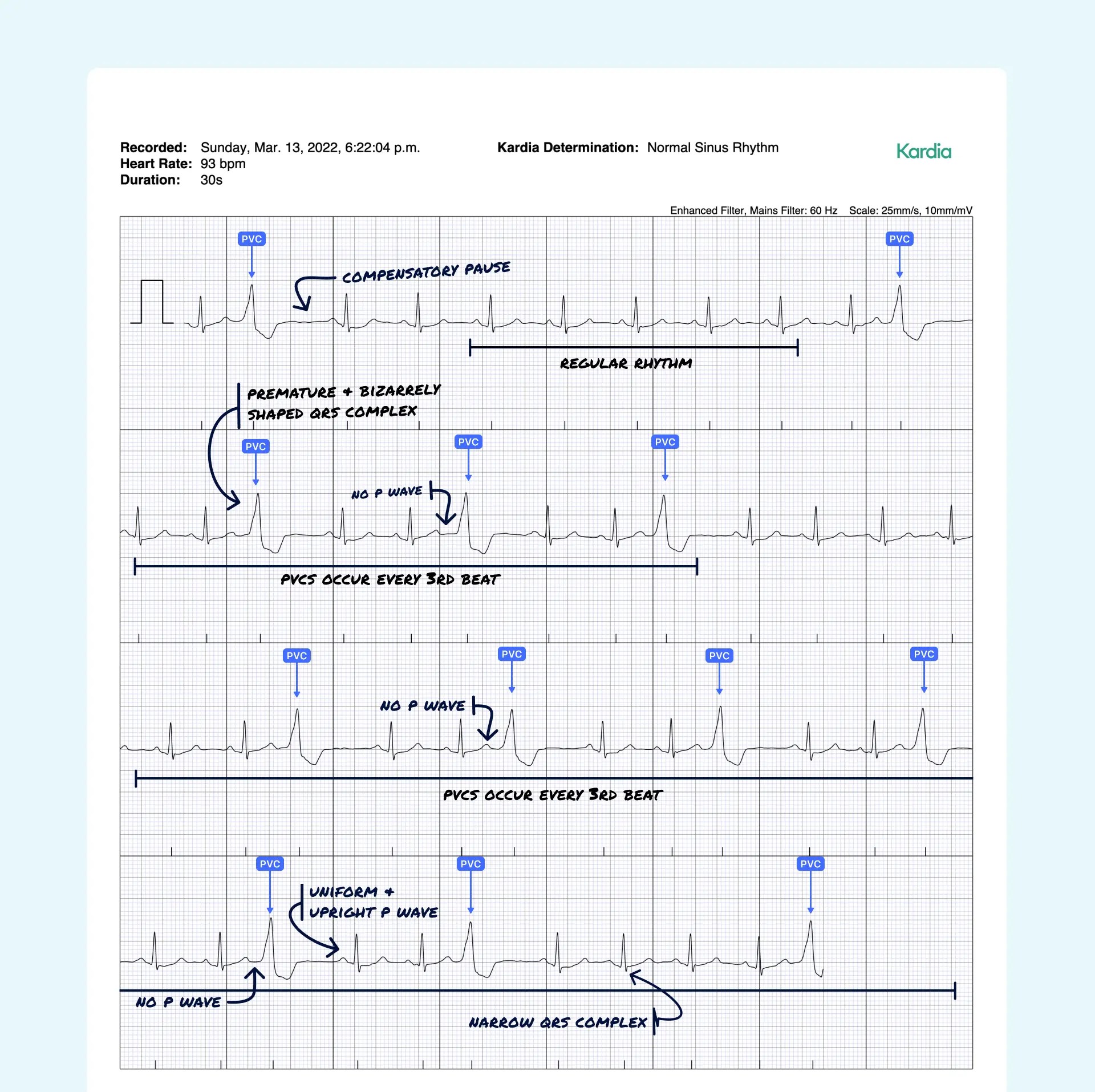 Premature Ventricular Contraction (Multiple) Vs. Ventricular Trigeminy