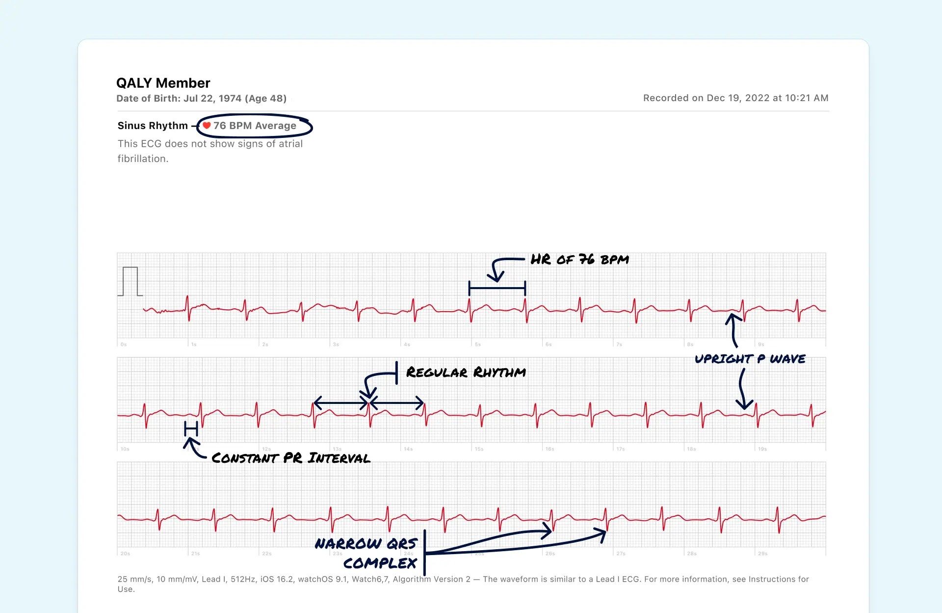Sinus Rhythm Vs. Ventricular Tachycardia (NonSustained) on Your Watch