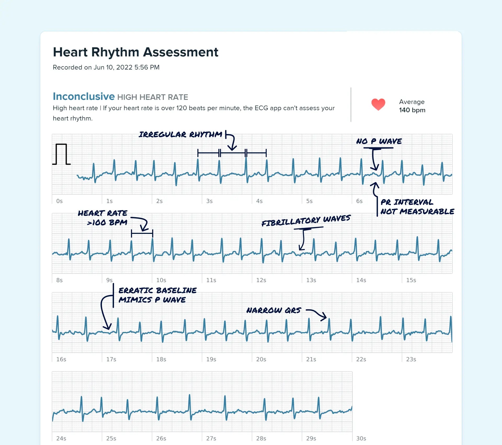 Ectopic Atrial Rhythm Vs. Atrial Fibrillation on Your Watch ECG Qaly