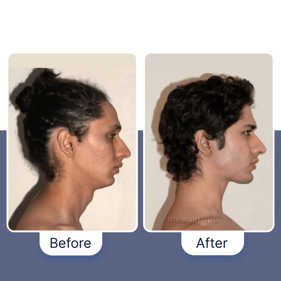 Mewing Before After 122 Progress Photos Male Female Transformations