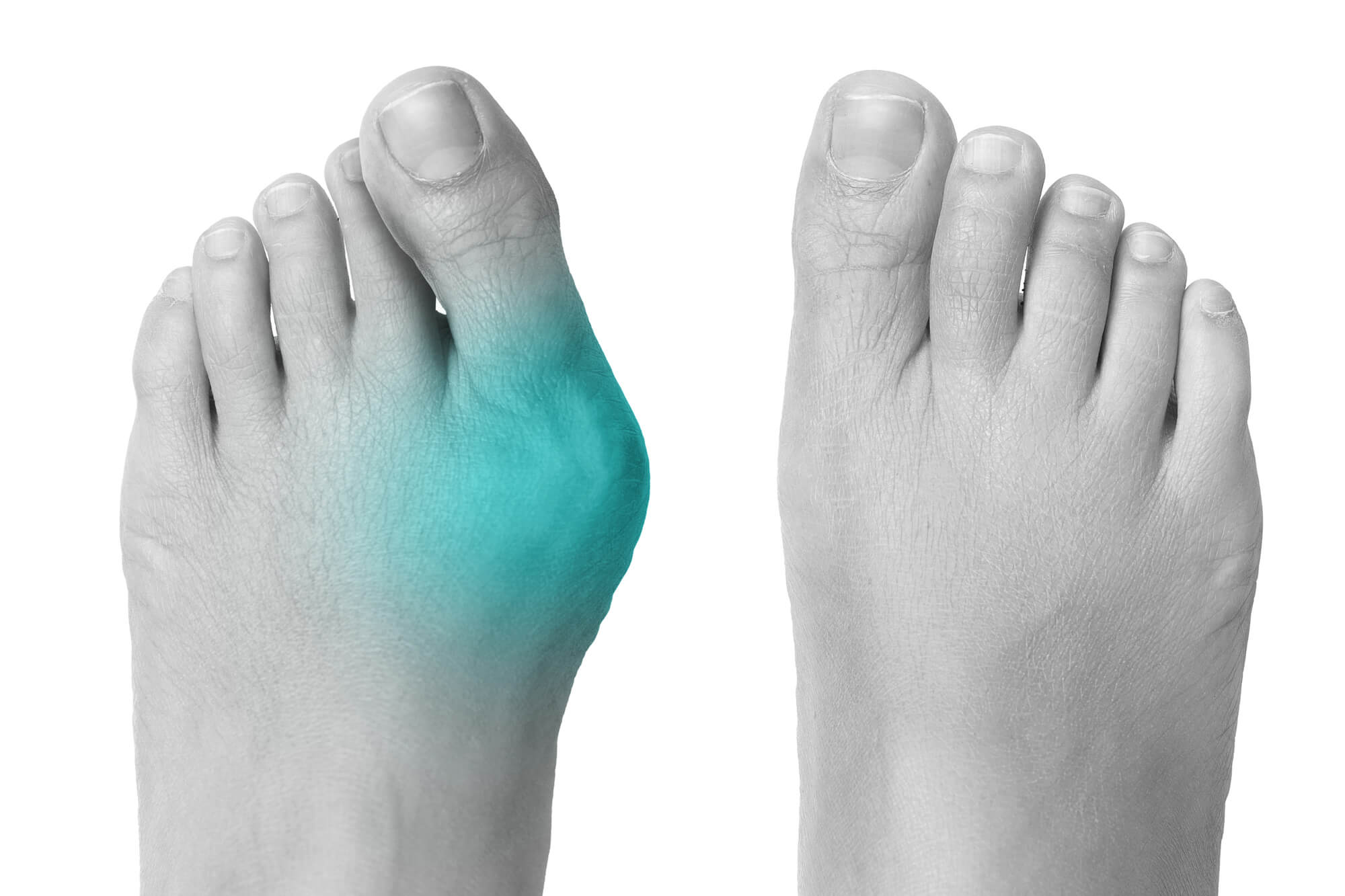 Bunions Mississauga Foot Clinic