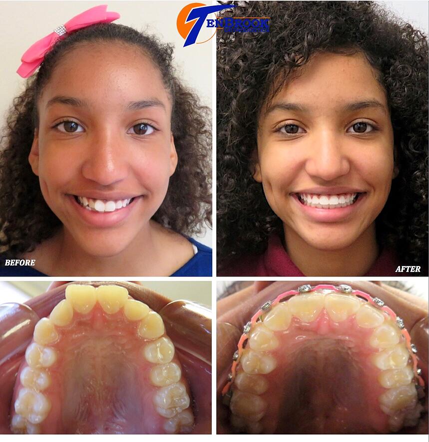 Top 103+ Pictures Palate Expander Before And After Photos Stunning