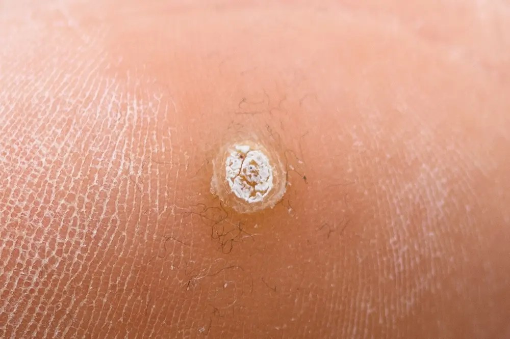 Plantar Warts (Verrucas) Diagnosis, Causes & Treatments