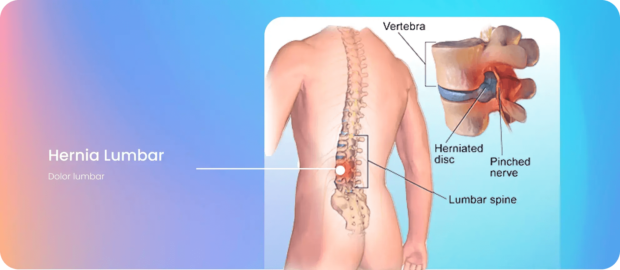 Hernia Lumbar