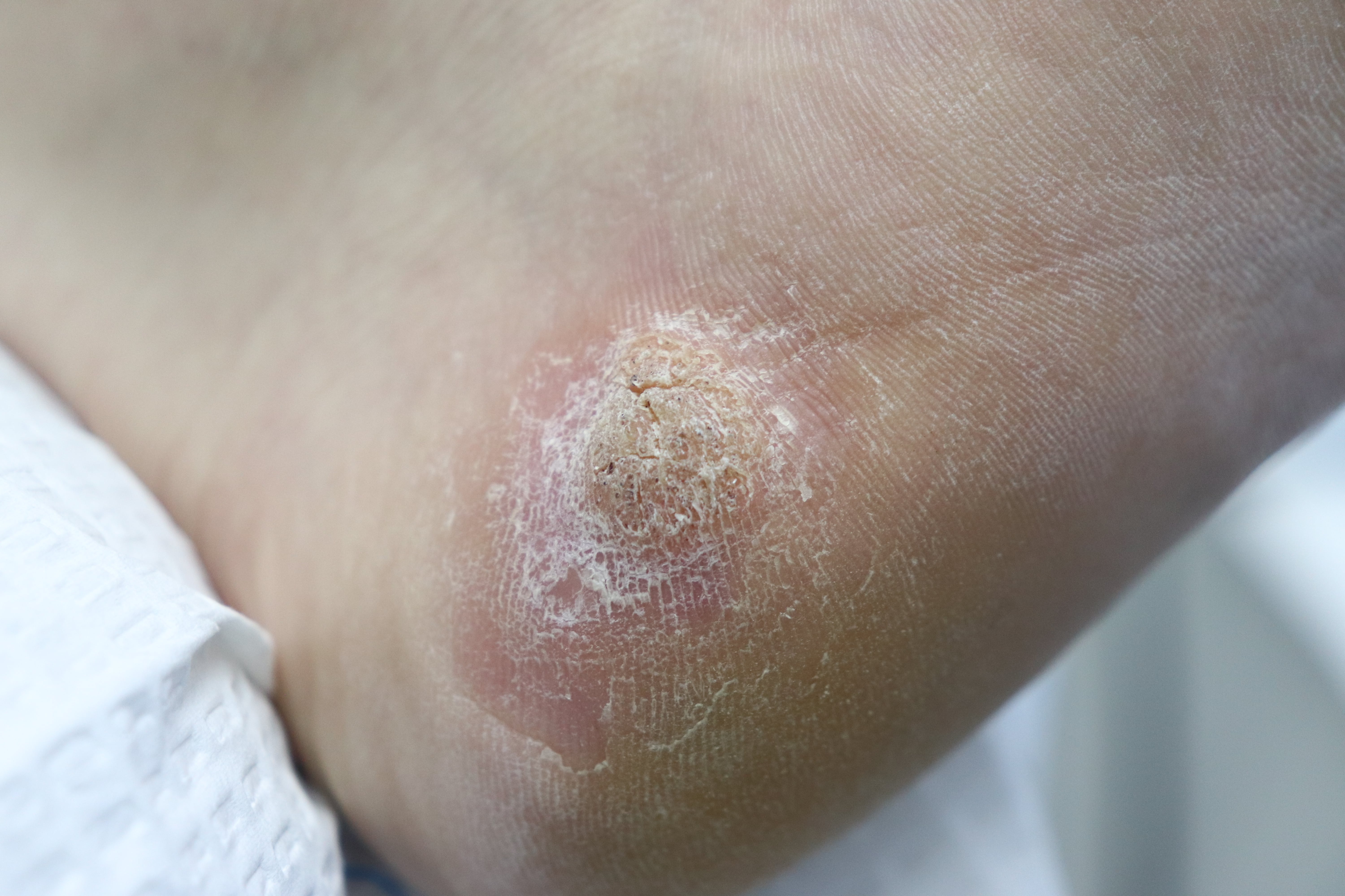 Plantar Warts What Causes Them and Symptoms to Look for