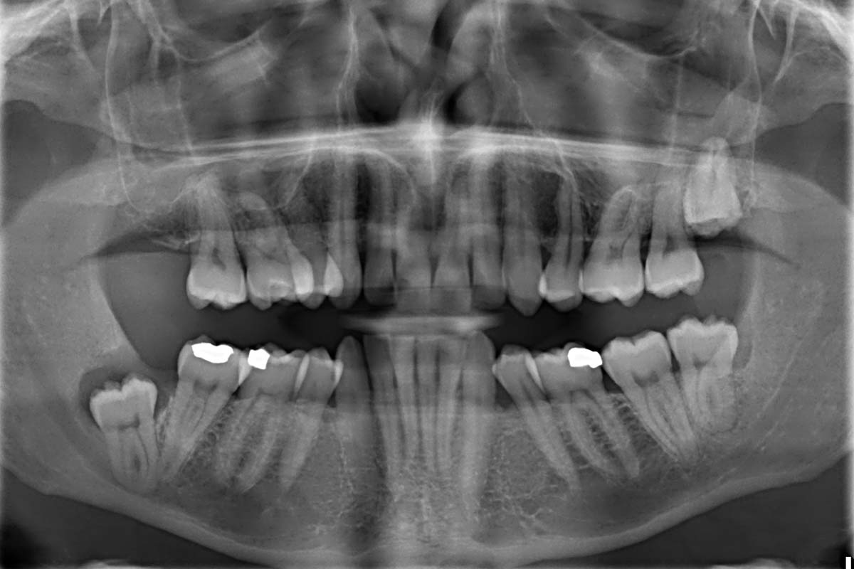 How Safe are Dental XRays? Bow Lane Dental Group