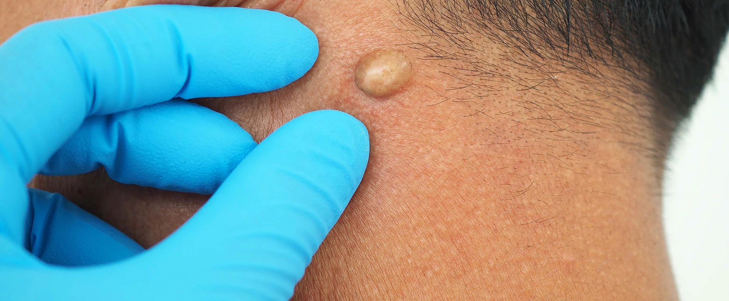 Fast relief with abscess/cyst drainage at Urgent Care