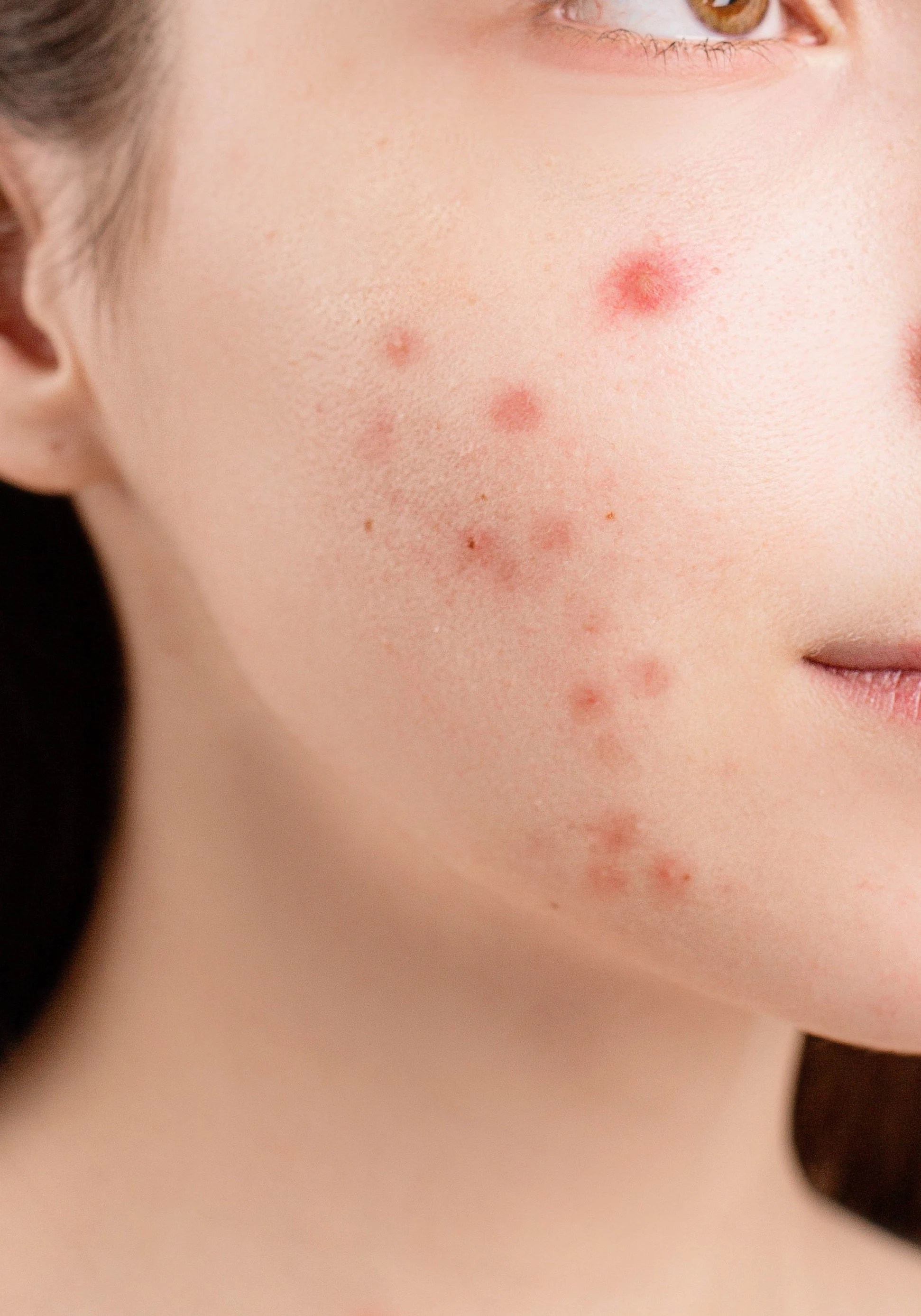 Acne and Face Rashes Life Coach