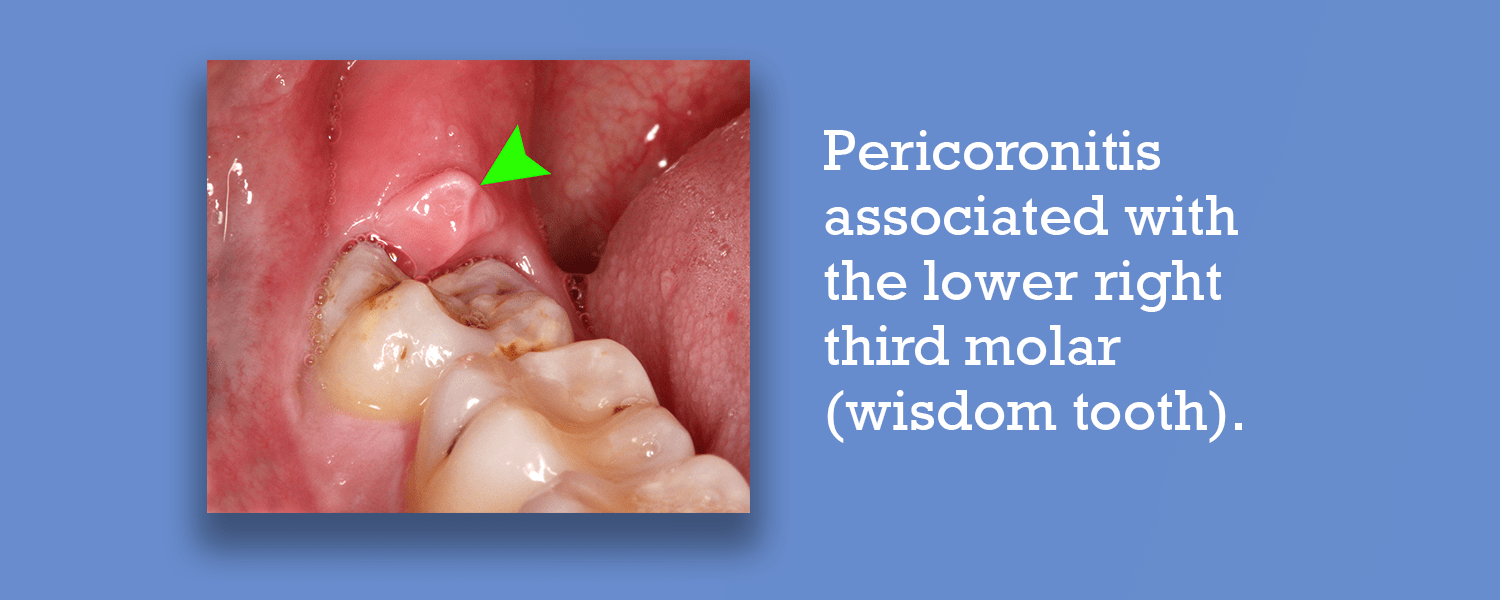 Pericoronitis Causes, Symptoms and Treatments CariFree