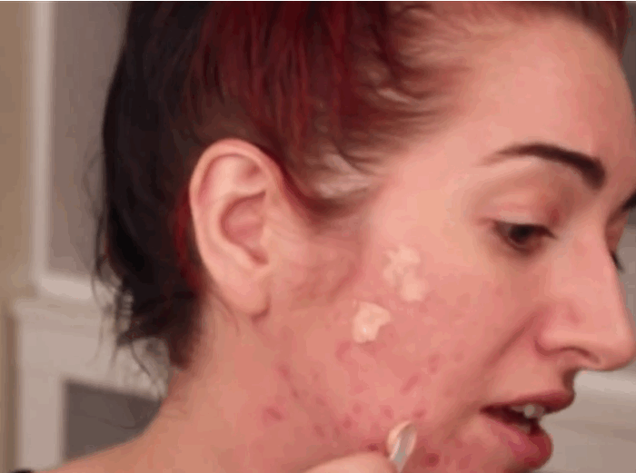 These 6 concealers can cover up your zits and heal them at These 6 concealers can cover up your zits and heal them at