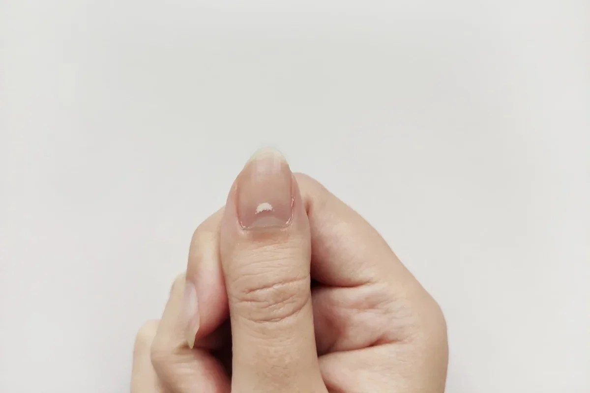 Manchas brancas na unha? Saiba o que pode ser e como tratar o problema