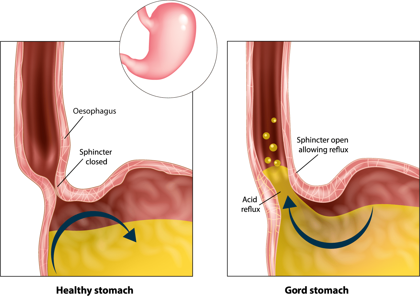 Reflux & Fundoplication Surgery Reflux Surgery UGIRS
