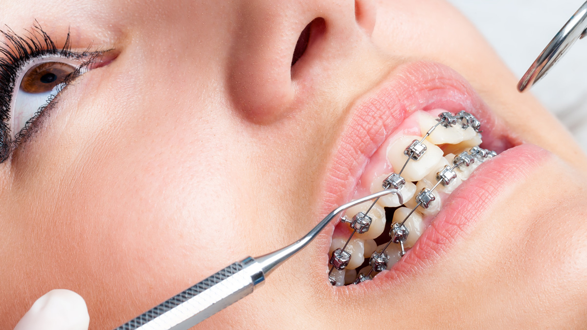 Advancements in Braces Technology Upstate Physicians