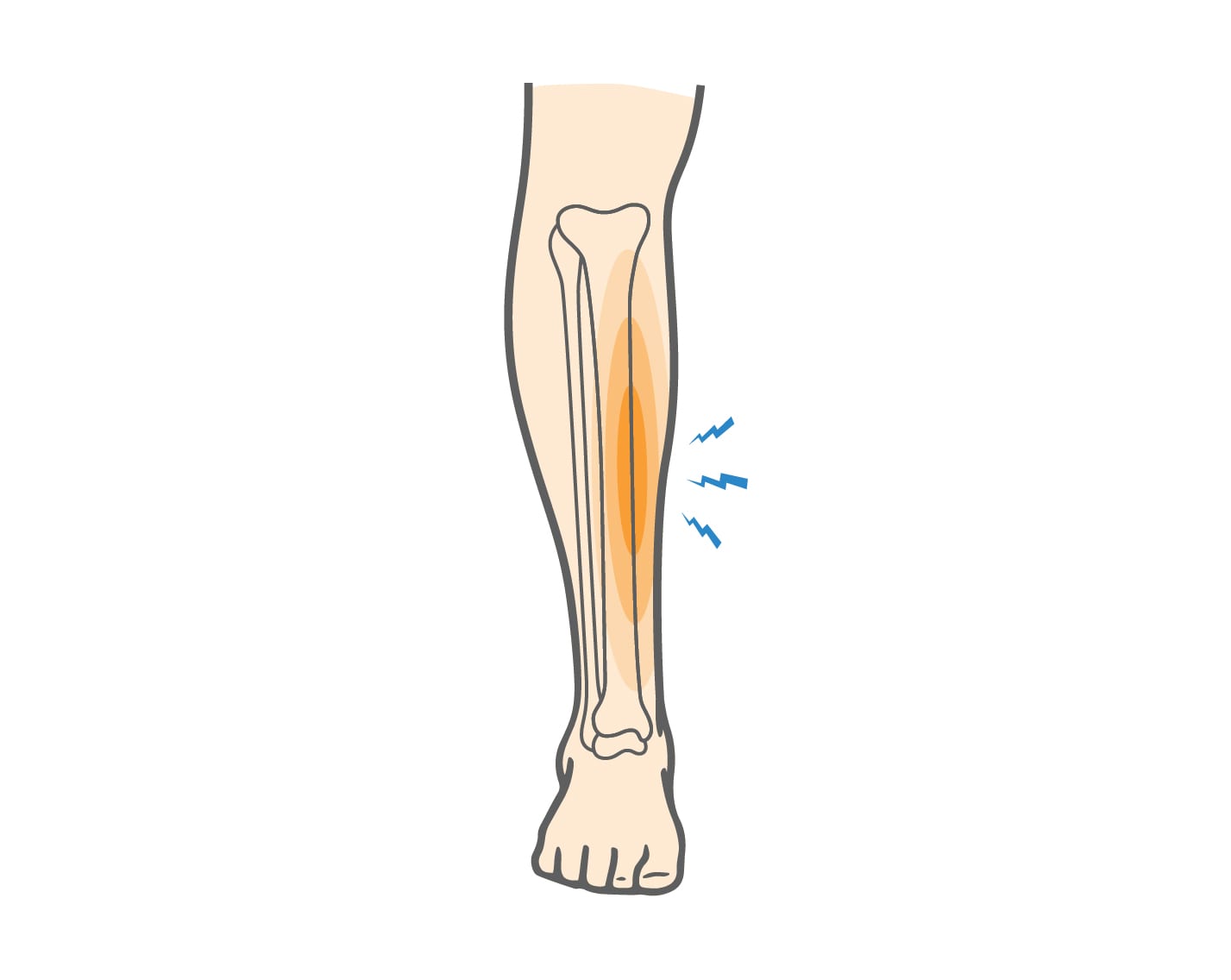 What are Shin Splints & How to Treat Lower Leg Pain? Upswing Health