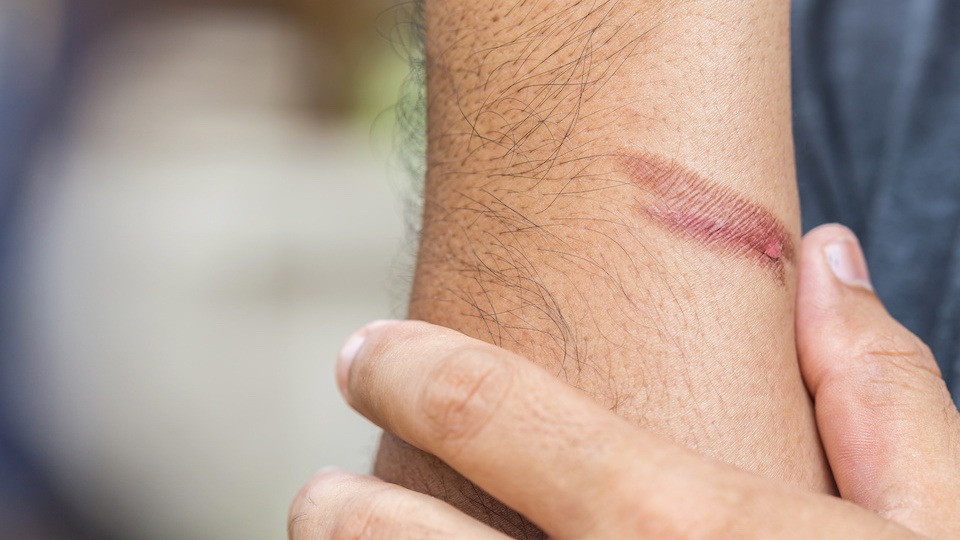 Never Put This on a Burn What to Do First