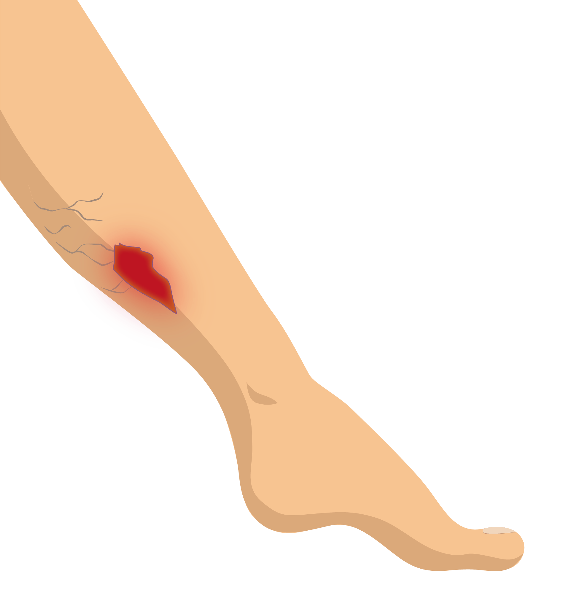 Sintético 92+ Foto Fotos De úlceras En La Pierna Alta Definición