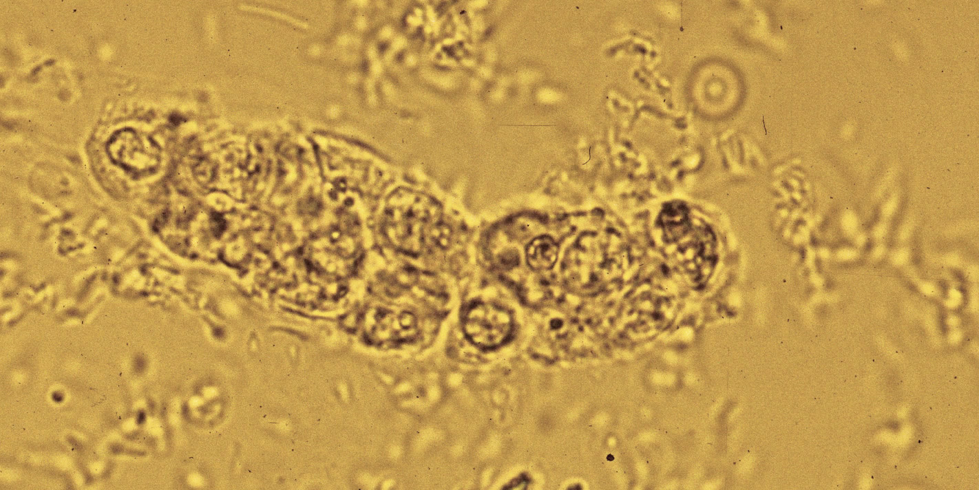 Renal tubular cells casts