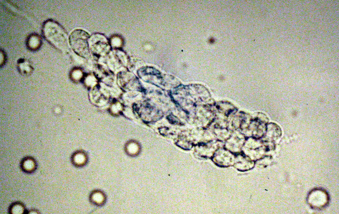 White blood cells casts