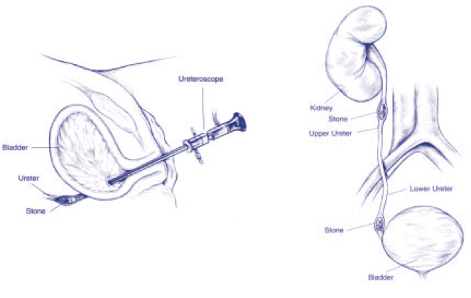 Ureteroscopy Our Services Urology Bay of Plenty