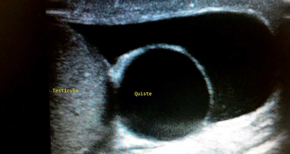 Ecografía testicular Ventajas y posibles diagnósticos