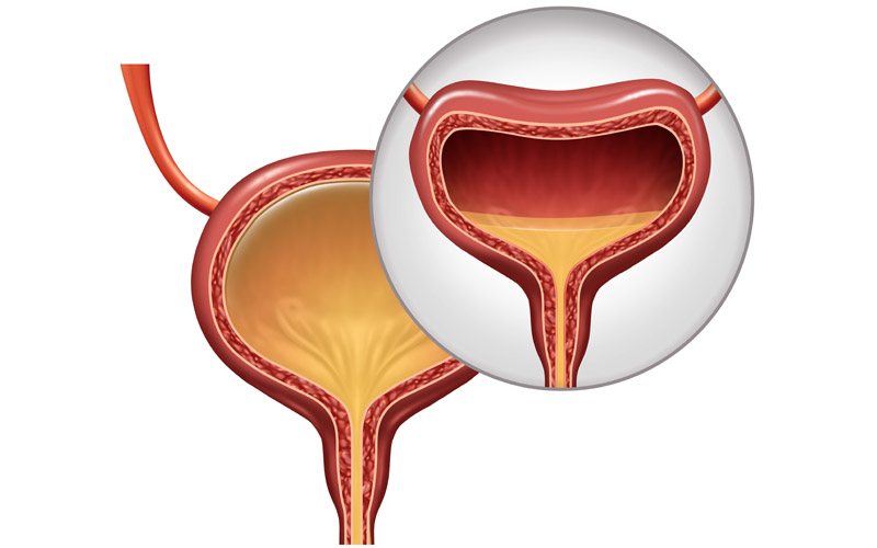 Overactive Bladder Urology Clinics of North Texas