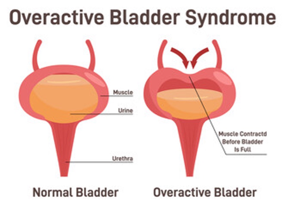 Your Overactive Bladder Matters Urology Clinics of North Texas